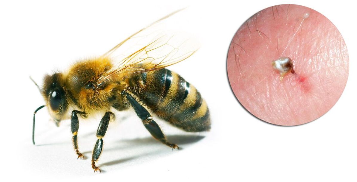 Hondrostrong содержит пчелиный яд, улучшающий обменные процессы в тканях. 